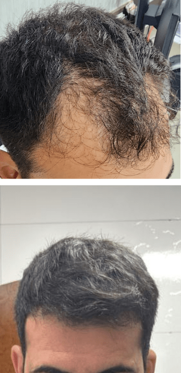 Transplante capilar - Dr Paulo Campos