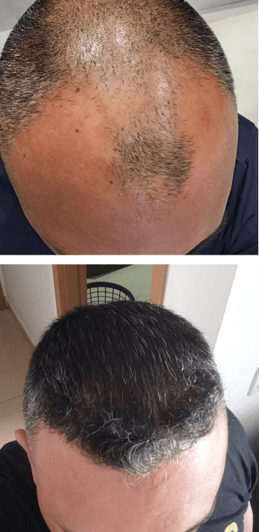 Transplante capilar - Dr Paulo Campos
