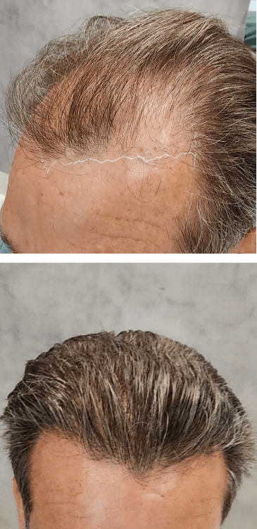 Transplante capilar - Dr Paulo Campos