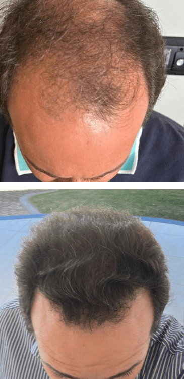 Transplante capilar