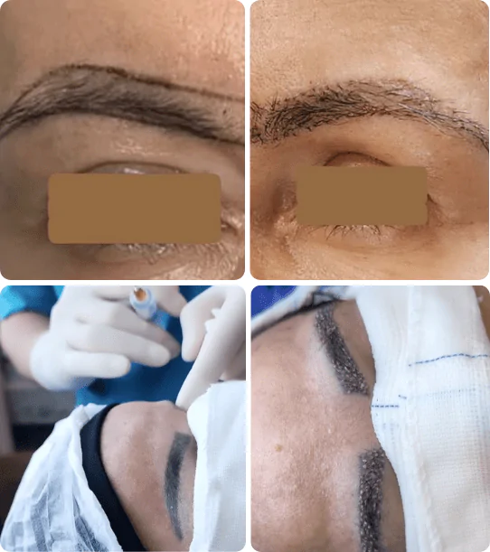 Transplante capilar - Dr Paulo Campos