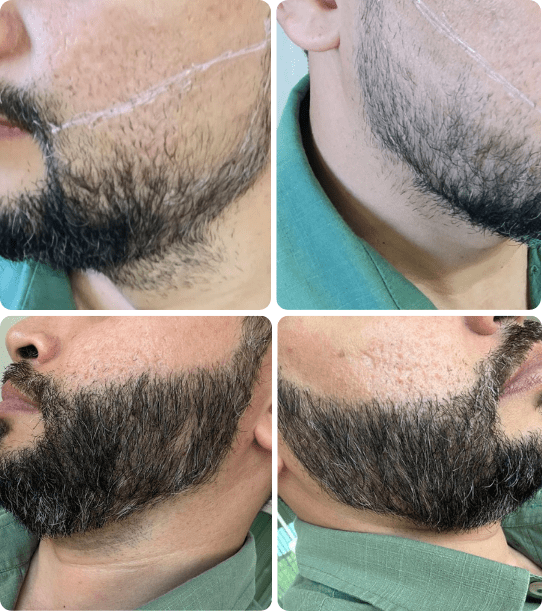 Transplante capilar - Dr Paulo Campos
