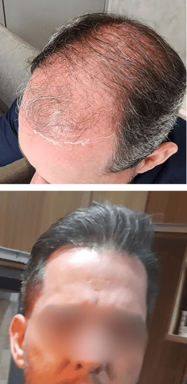 Transplante capilar - Dr Paulo Campos