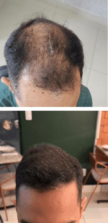 Transplante capilar - Dr Paulo Campos