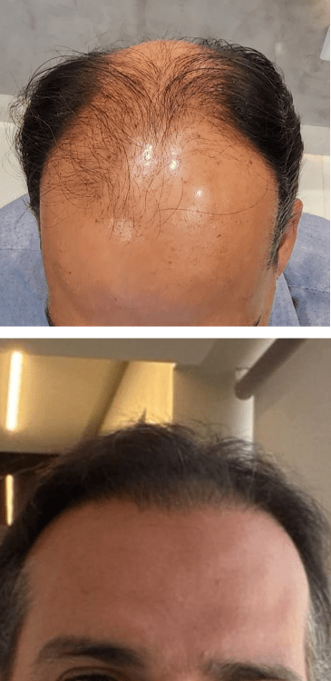 Transplante capilar - Dr Paulo Campos