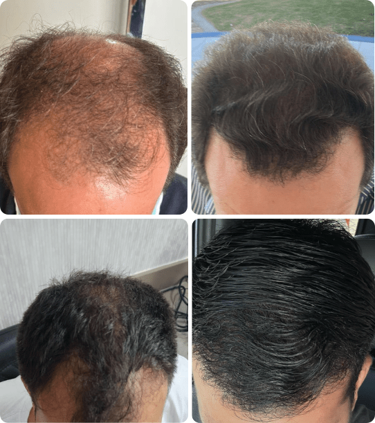 Transplante capilar - Dr Paulo Campos