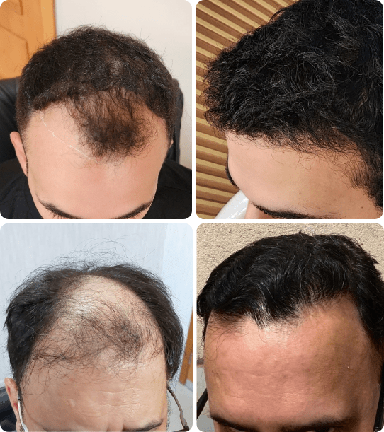 Transplante de Cabelo