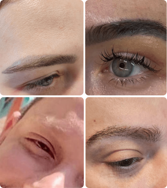 Transplante de Sobrancelhas